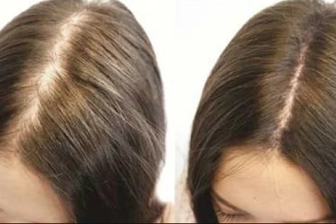 pérdida del cabello por alopecia