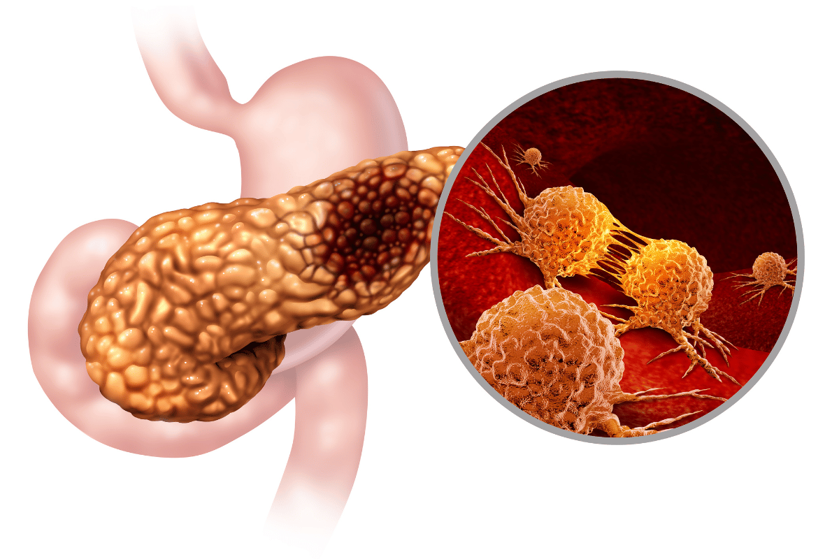 pancreatitis aguda del páncreas